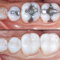 Restorations in teeth (Fillings)