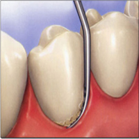 Scaling & Polishing of teeth